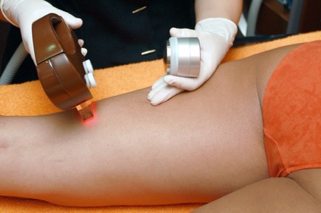 epilation definitive lyon